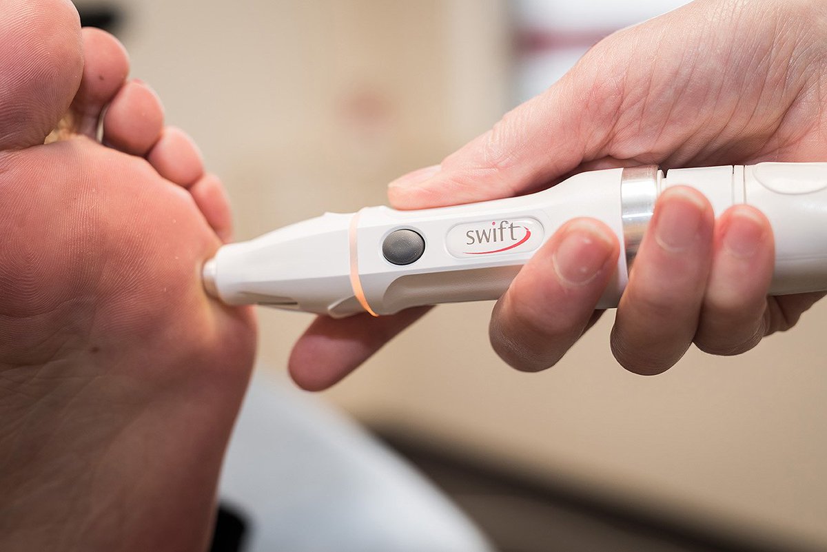 Microwave away your verrucae & warts! with SWIFT microwave therapy