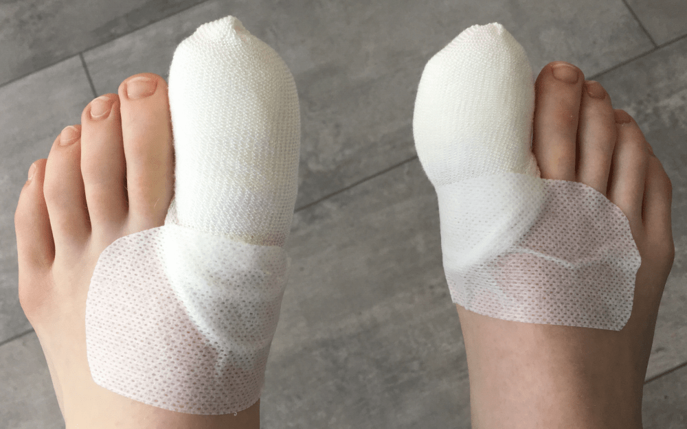 Toe Nail Surgery Zest Podiatry Physio Why Wait Till It Hurts