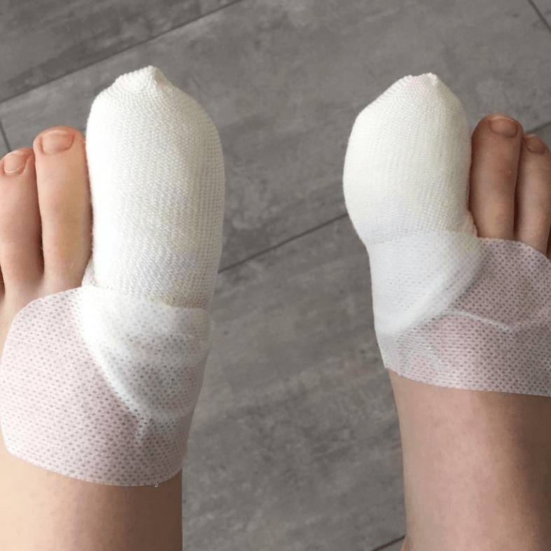 Nail Surgery for ingrown toenails