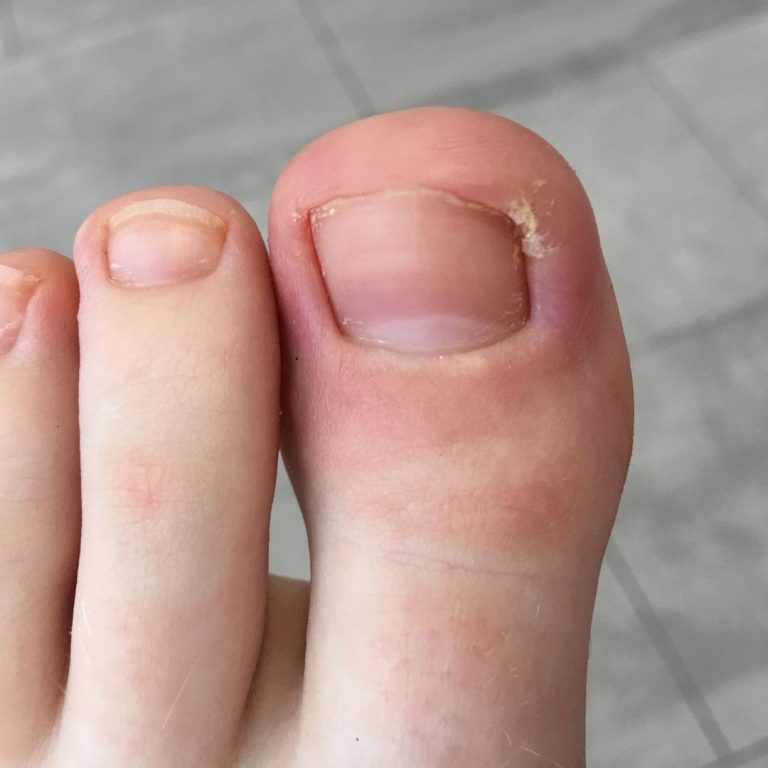 Ingrown Sore Nails And Nail Surgery Zest Podiatry And Physio A Case Study
