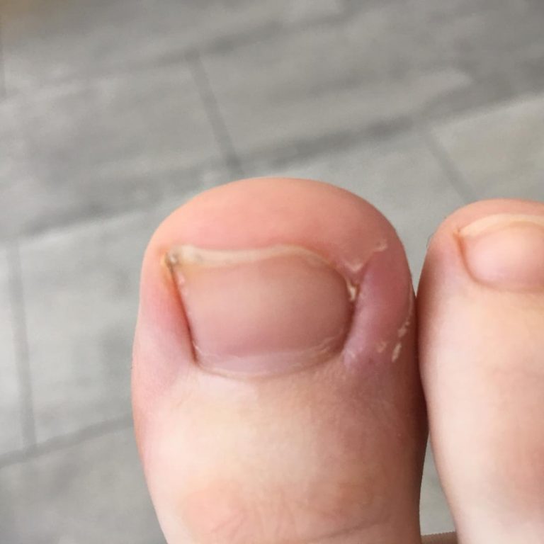 Ingrown sore nails & nail surgery - Zest Podiatry & Physio - A case study.